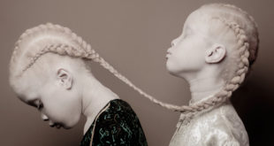 Lara, Mara, Sheila, Twins, albino, albinism, white, black, Mind Blowing Facts, Facts, Fact, Weird World, World of Wonders, Unbelievable facts, Some Amazing Facts