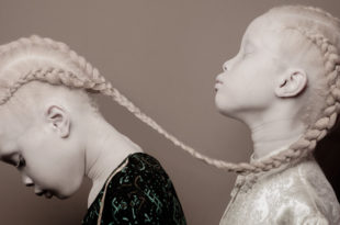 Lara, Mara, Sheila, Twins, albino, albinism, white, black, Mind Blowing Facts, Facts, Fact, Weird World, World of Wonders, Unbelievable facts, Some Amazing Facts